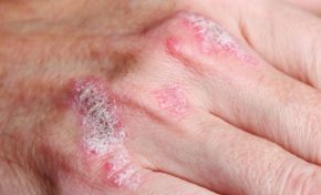 Redes sociais aliadas à causa da psoríase