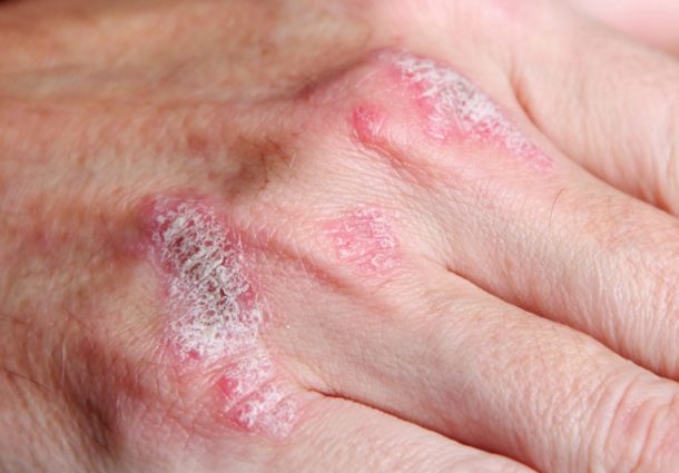 Redes sociais aliadas à causa da psoríase