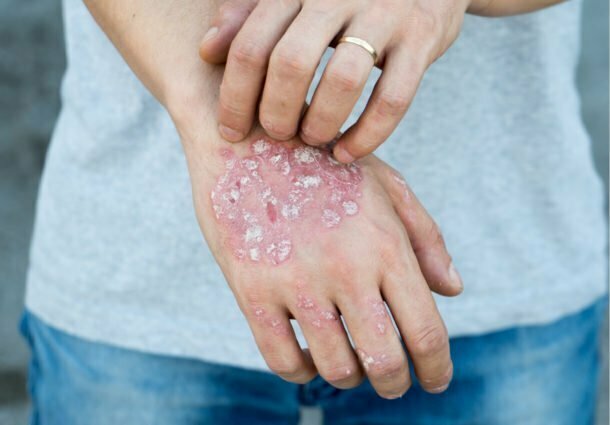 Pacientes com psoríase contam com terapias imunobiológicas em planos privados