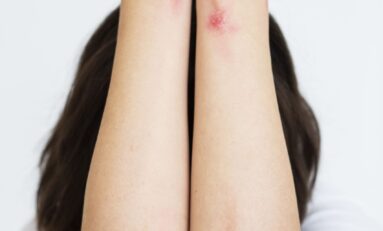 Psoríase Brasil promove 3º Simpósio Doenças Crônicas de Pele em São Paulo