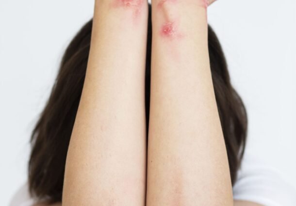 Psoríase Brasil promove 3º Simpósio Doenças Crônicas de Pele em São Paulo