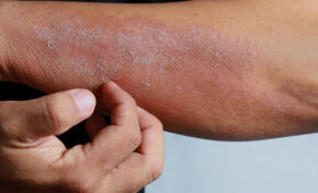 3º Simpósio de Doenças Crônicas de Pele evidencia a necessidade de aprimoramento de políticas públicas aos pacientes 