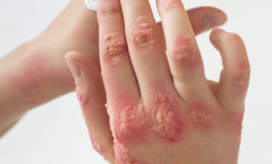 Doenças crônicas de pele em pauta na Câmara dos Deputados