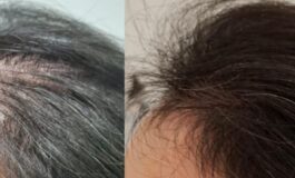 Tricologia: demanda crescente de ciência dedicada à saúde dos cabelos e couro cabeludo