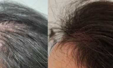 Tricologia: demanda crescente de ciência dedicada à saúde dos cabelos e couro cabeludo