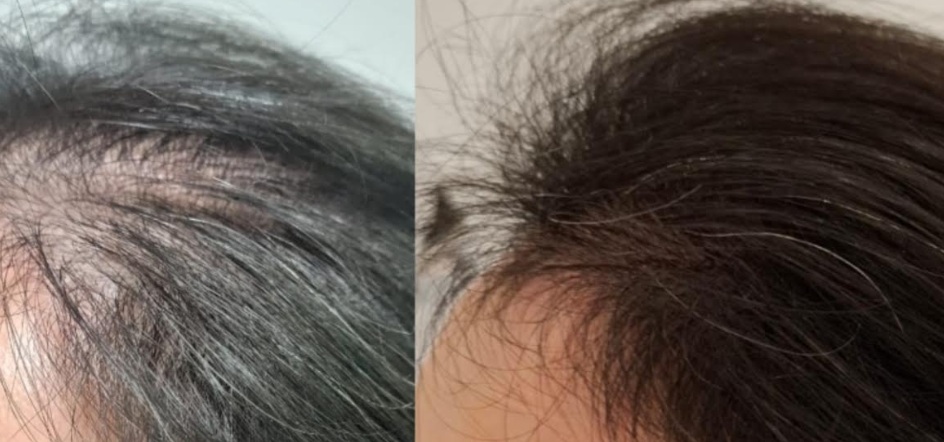 Tricologia: demanda crescente de ciência dedicada à saúde dos cabelos e couro cabeludo